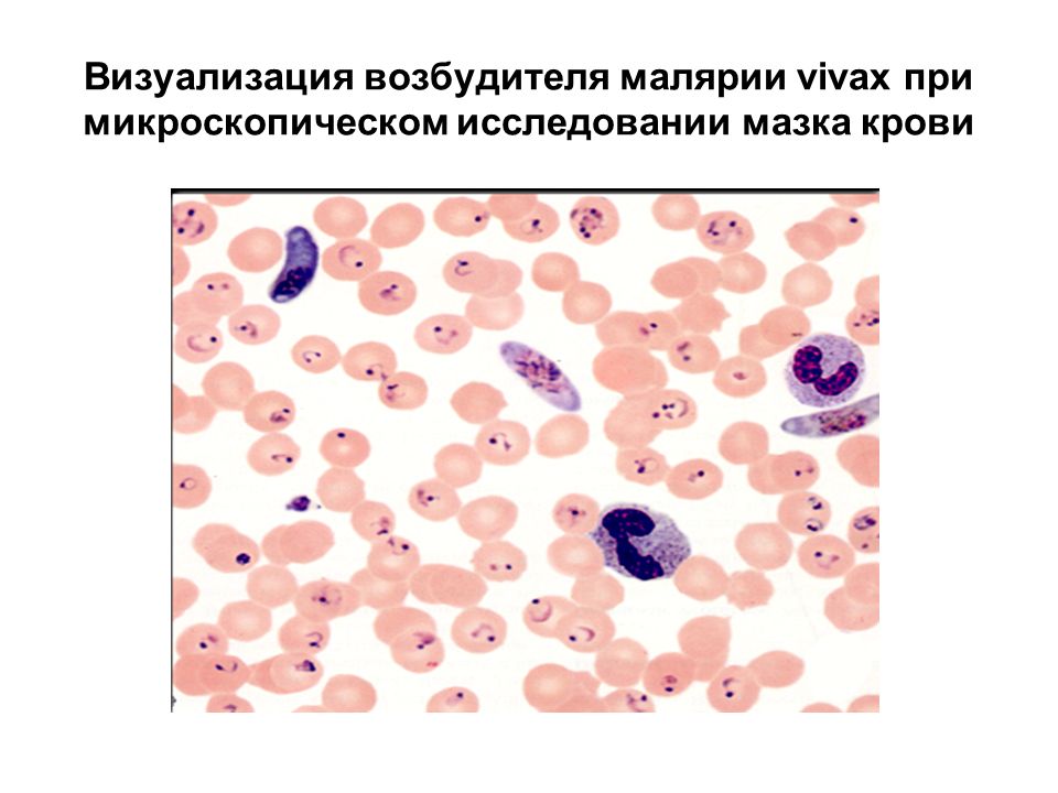 Кровь на малярию. Микроскопия толстой капли крови при малярии. Малярия мазок крови микроскопия. Малярийный плазмодий микроскопия. Микроскопия крови при малярии.