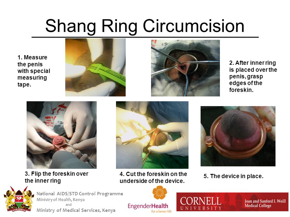 National AIDS/STD Control Programme Ministry of Health, Kenya and Ministry  of Medical Services, Kenya Pilot Study of the Shang Ring: A Novel Male  Circumcision. - ppt download
