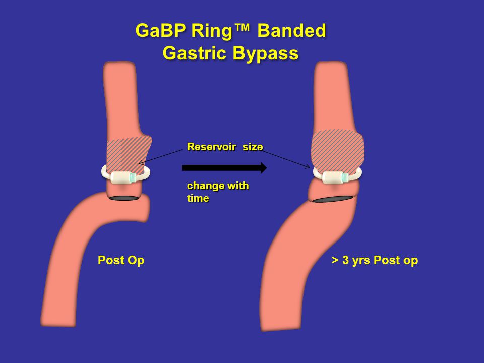 inschakelen verdediging specificatie The GaBP Ring Device For Banding The Pouch in Gastric Bypass and Sleeve  Gastrectomy Operations Bariatec Corporation P.O Box 4257 Palos Verdes  Peninsula, - ppt download