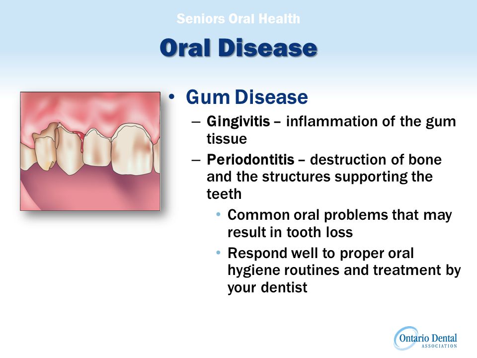 Seniors Oral Health Oral Disease Gum Disease – Gingivitis – inflammation of the gum tissue – Periodontitis – destruction of bone and the structures supporting the teeth Common oral problems that may result in tooth loss Respond well to proper oral hygiene routines and treatment by your dentist