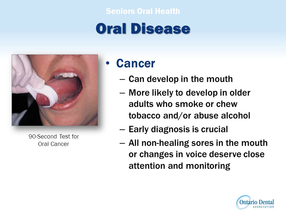 Seniors Oral Health Oral Disease Cancer – Can develop in the mouth – More likely to develop in older adults who smoke or chew tobacco and/or abuse alcohol – Early diagnosis is crucial – All non-healing sores in the mouth or changes in voice deserve close attention and monitoring 90-Second Test for Oral Cancer