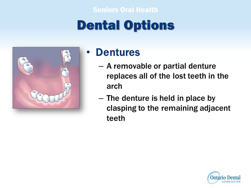 Seniors Oral Health Dental Options Dentures – A removable or partial denture replaces all of the lost teeth in the arch – The denture is held in place by clasping to the remaining adjacent teeth