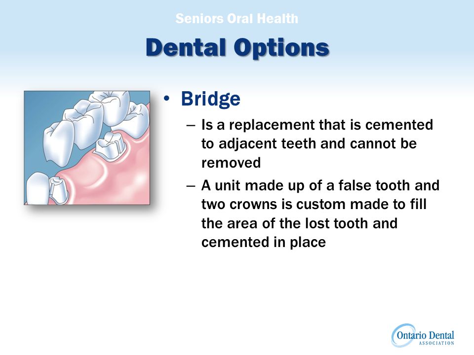 Seniors Oral Health Dental Options Bridge – Is a replacement that is cemented to adjacent teeth and cannot be removed – A unit made up of a false tooth and two crowns is custom made to fill the area of the lost tooth and cemented in place