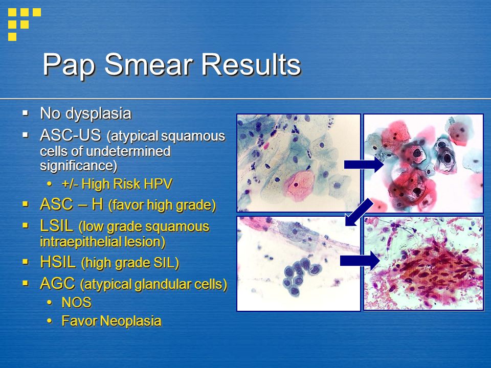 hpv abnormal squamous cells ejjeli fergek port