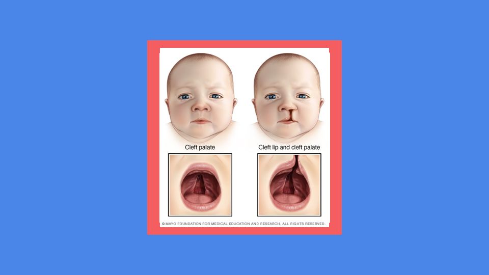 Digeorge Syndrome Ppt Download Digeorge Syndrome Ppt Download