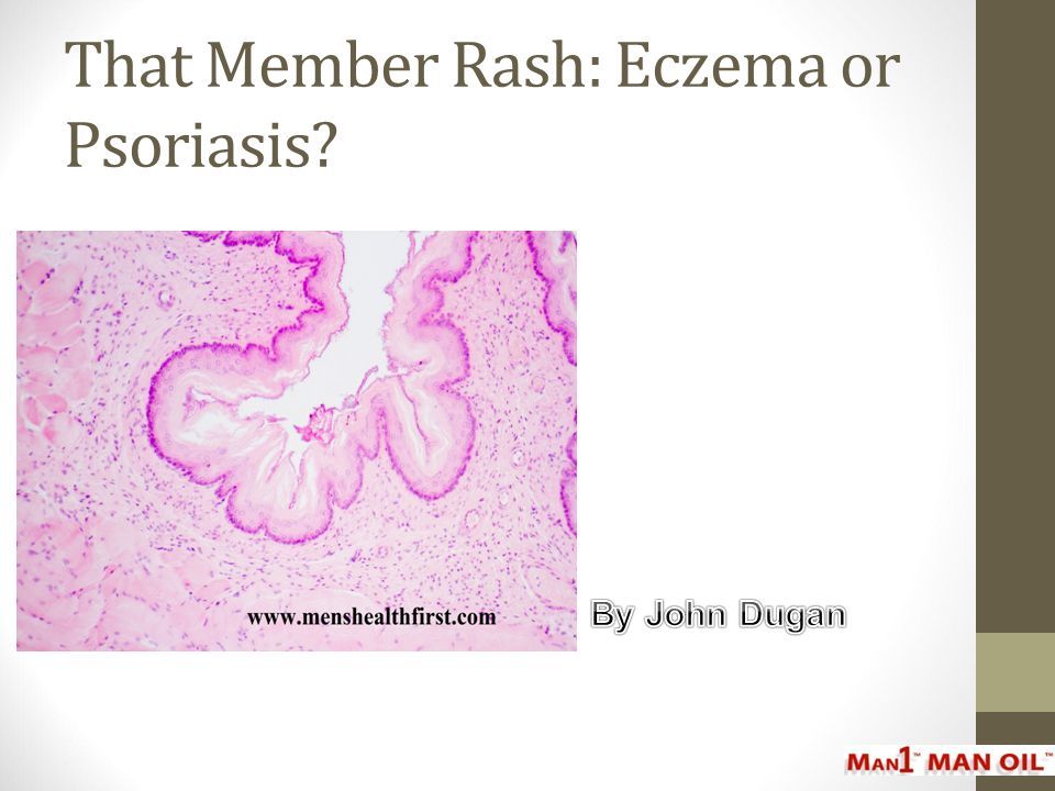 That Member Rash: Eczema or Psoriasis