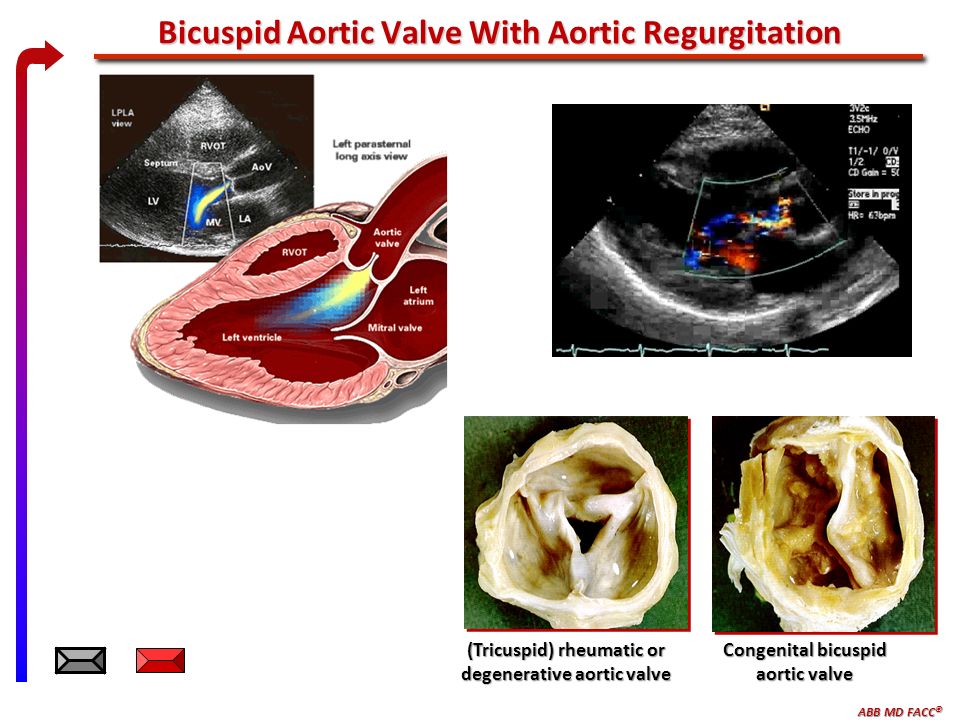 ABB MD FACC © Bicuspid Aortic Valve With Aortic Regurgitation (Tricuspid) rheumatic or degenerative aortic valve Congenital bicuspid aortic valve