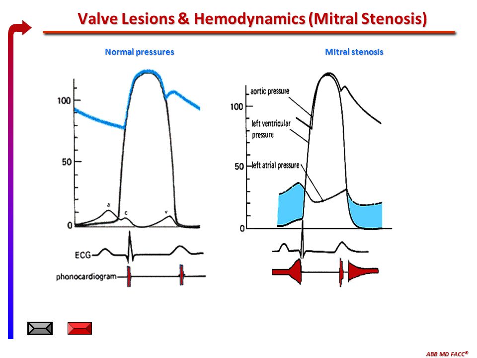 ABB MD FACC © Valve Lesions & Hemodynamics (Mitral Stenosis) Normal pressures Mitral stenosis