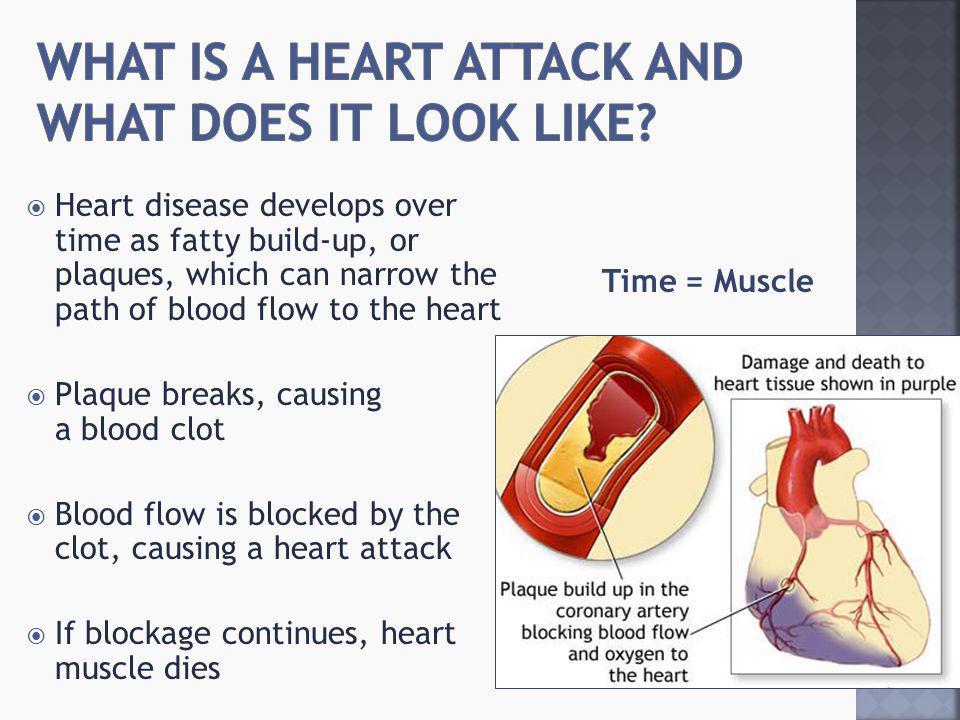  Heart disease develops over time as fatty build-up, or plaques, which can narrow the path of blood flow to the heart  Plaque breaks, causing a blood clot  Blood flow is blocked by the clot, causing a heart attack  If blockage continues, heart muscle dies Time = Muscle