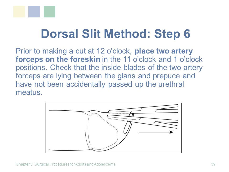 Slit procedure dorsal