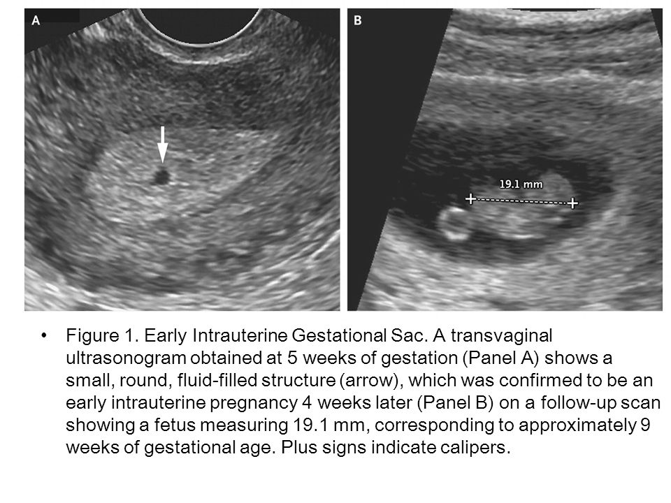 Figure 1. Early Intrauterine Gestational Sac. 
