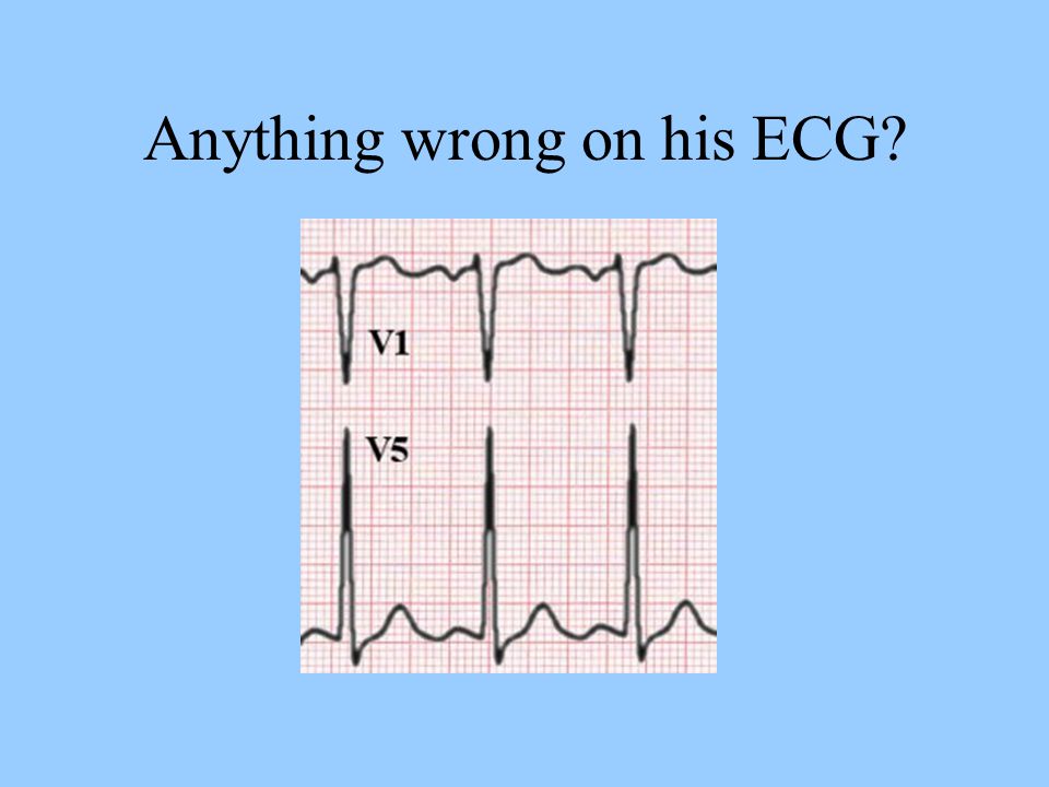 Anything wrong on his ECG