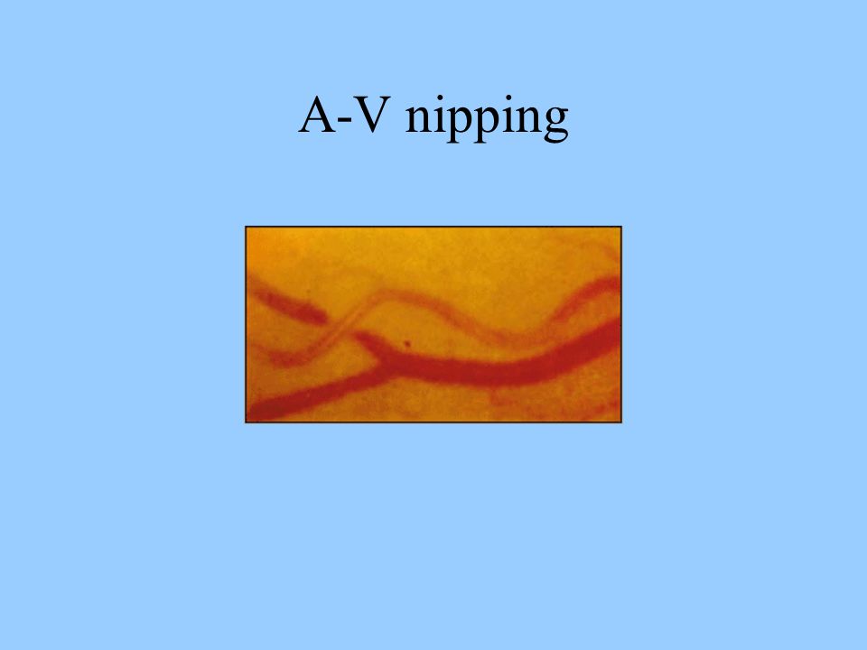 A-V nipping