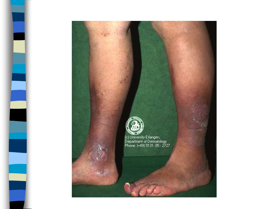varicele membrelor inferioare operaiuni în pereii varicoi pe picioarele pericol-reviews