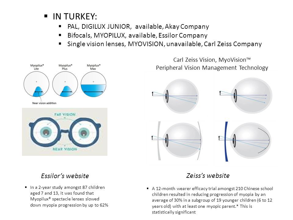  IN TURKEY:  PAL, DIGILUX JUNIOR, available, Akay Company  Bifocals, MYOPILUX, available, Essilor Company  Single vision lenses, MYOVISION, unavailable, Carl Zeiss Company Carl Zeiss Vision, MyoVision™ Peripheral Vision Management Technology  A 12-month wearer efficacy trial amongst 210 Chinese school children resulted in reducing progression of myopia by an average of 30% in a subgroup of 19 younger children (6 to 12 years old) with at least one myopic parent.* This is statistically significant Zeiss’s website  In a 2-year study amongst 87 children aged 7 and 13, it was found that Myopilux® spectacle lenses slowed down myopia progression by up to 62% Essilor’s website