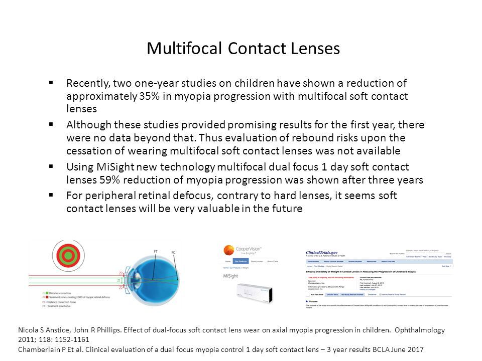 Multifocal Contact Lenses  Recently, two one-year studies on children have shown a reduction of approximately 35% in myopia progression with multifocal soft contact lenses  Although these studies provided promising results for the first year, there were no data beyond that.