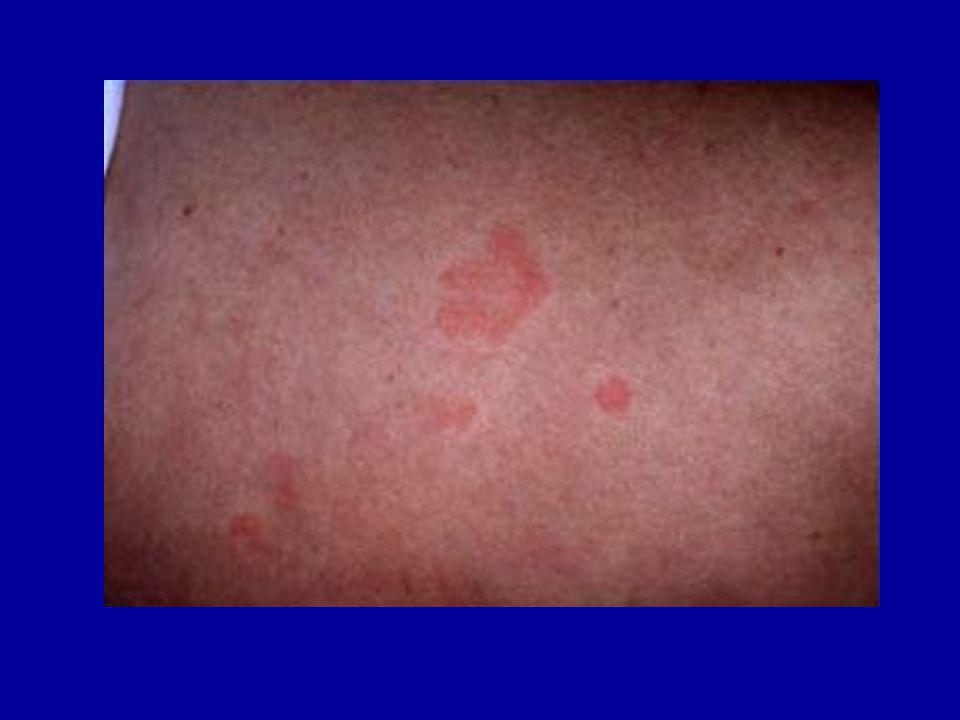 Occasional Urticaria Occasional Urticaria