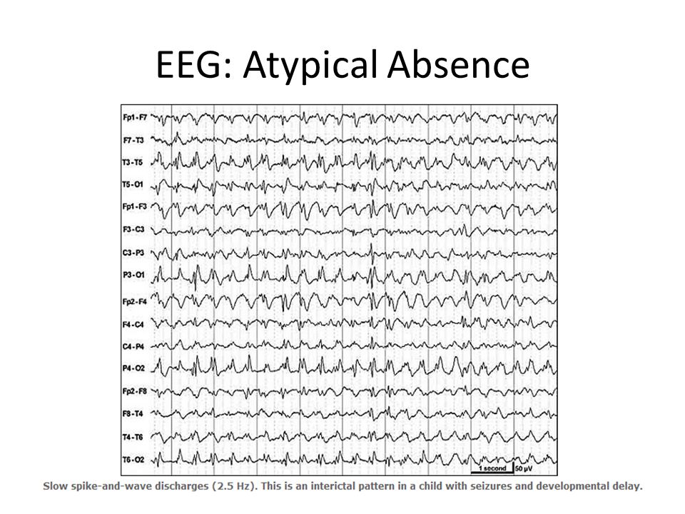 absence seizure eeg