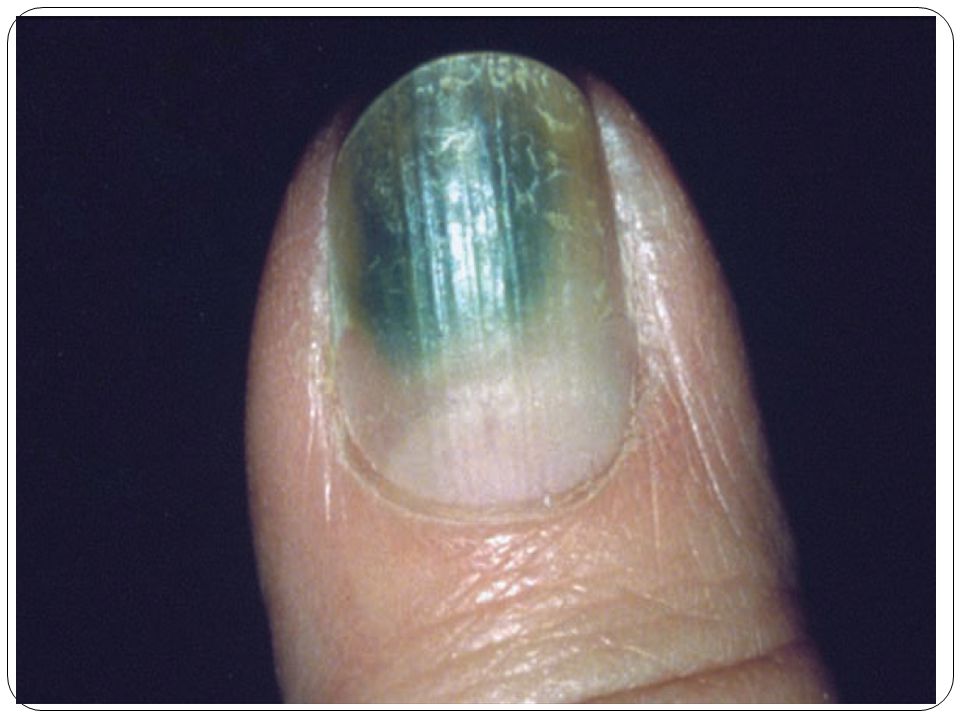 Shafiepour,mohsen MD. Kerman university of medical sciences Green nail  syndrome. - ppt download
