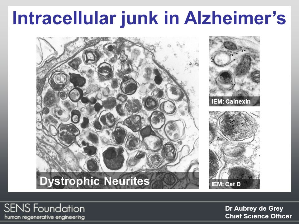 Dr Aubrey de Grey Chief Science Officer Intracellular junk in Alzheimer’s IEM: Calnexin Dystrophic Neurites IEM: Cat D