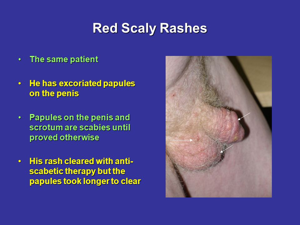 Red scaly rashes Dr. D. Czarnecki MD MB BS. Red Scaly Rashes When someone  presents with a red, scaly, itchy rashWhen someone presents with a red,  scaly, - ppt download