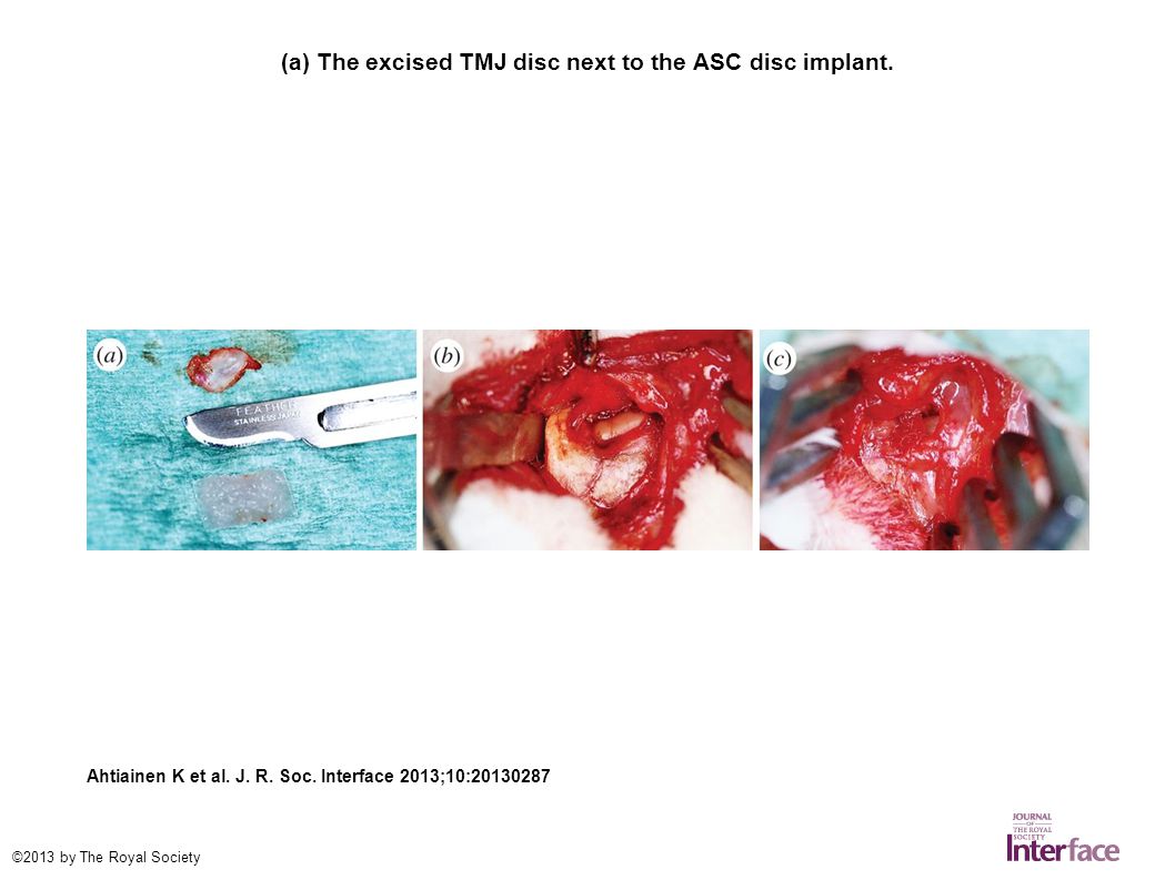 (a) The excised TMJ disc next to the ASC disc implant.
