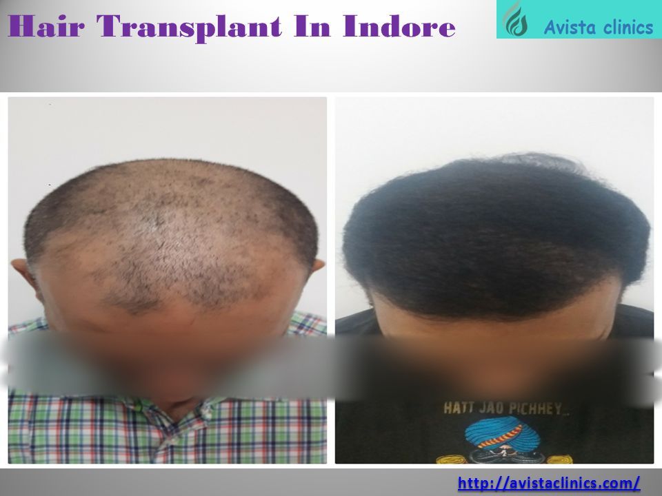 ABOUT US Among various hair clinics spread over the city, Avista Clinics  has been the Best Hair Transplant Center In Indore up until now. Special  focus. - ppt download
