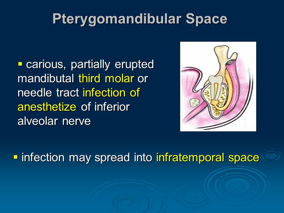 pterygomandibular space abscess